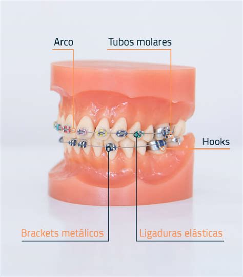 brackets metalicos tipos|partes de un bracket.